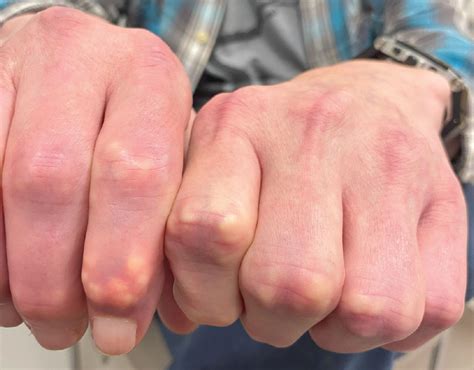 Swelling On Finger Pad at Kimberly Clifton blog