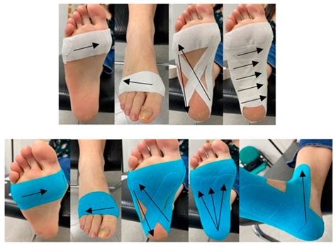 Taping Plantar Fasciitis Treatment
