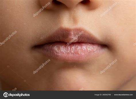 Chapped Lips Bleeding Toddler at Chelsea Elyard blog