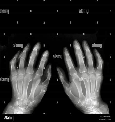 X ray hands arthritis hi-res stock photography and images - Alamy
