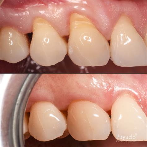 Gingival Recession: What is it and how to treat it? - Clínica Dental Puyuelo
