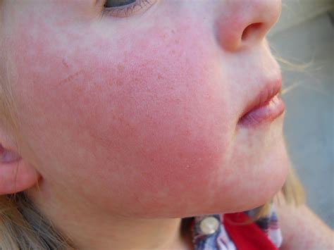 Strep Infection Rash On Legs at Humberto Watts blog