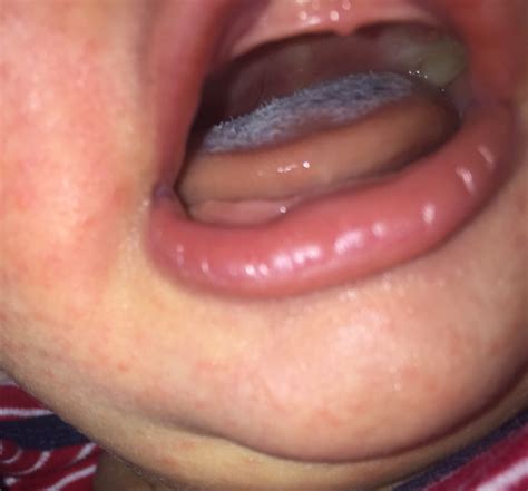 Why Do I Have Little Black Spots On My Tongue - Infoupdate.org