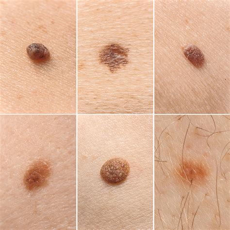 Common Skin Mole
