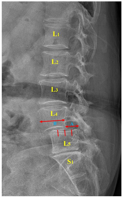Spondylolisthesis Grade