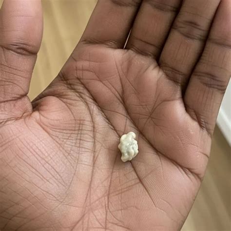 Here’s what you need to know about tonsil stones – the weird pimple-like growths in your throat