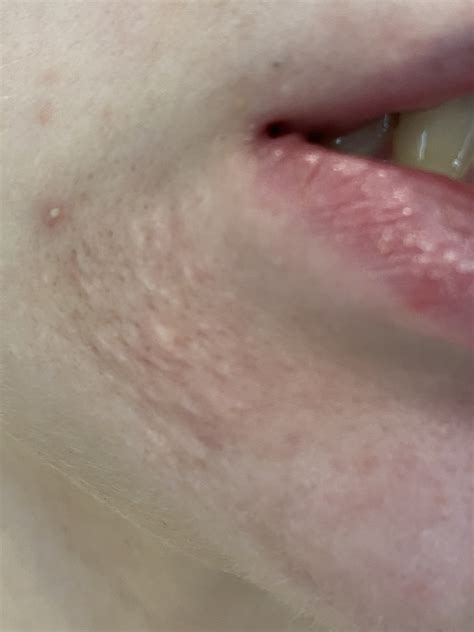 Bumps on chin (sebaceous hyperplasia?) – Acne – Acne.org Forum