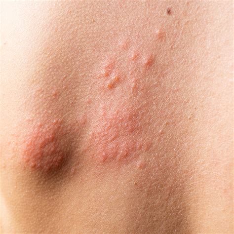 Hives vs Eczema