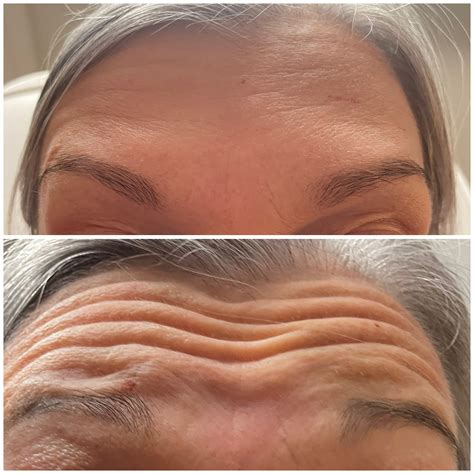 Botox on forehead lines