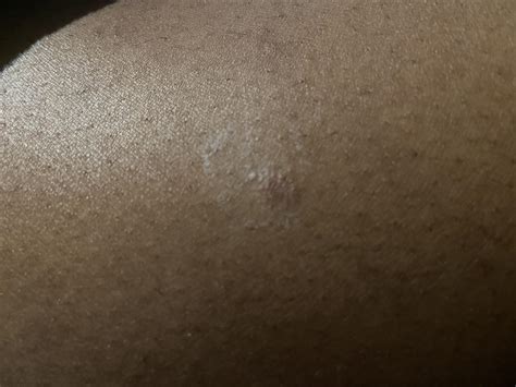 Pityriasis rosea or ring worm? : r/PityriasisRosea