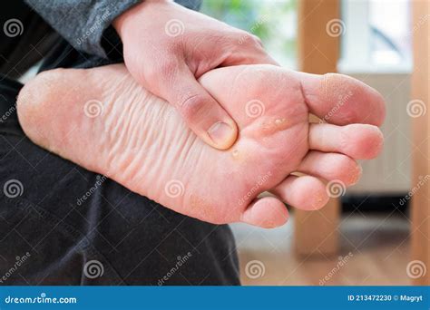Foot with Corns, Calluses and Dry Skin, Wart Plantar Verrucas. Verrucas ...