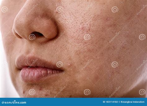 Pimples In Mouth