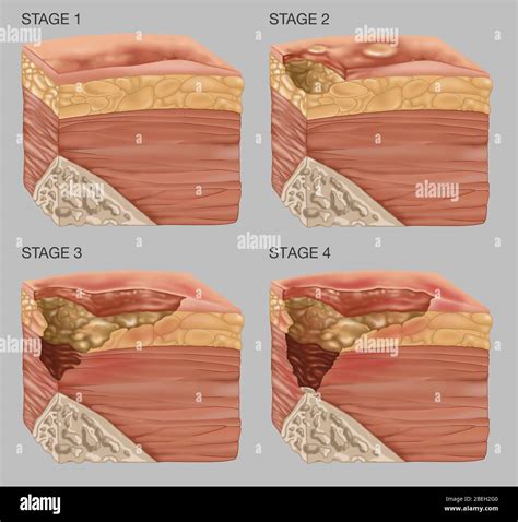 4 Stages of a Bedsore, Illustration Stock Photo - Alamy