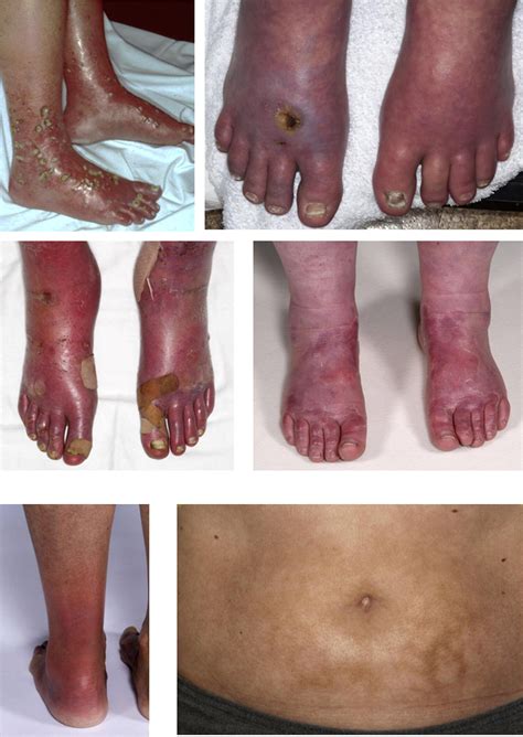 Immersion foot associated with the overuse of ice, cold water, and fans ...