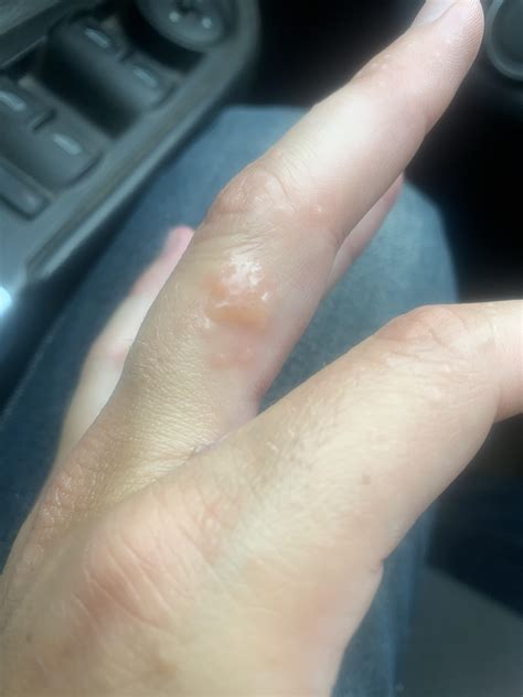 Eczema Bumps On Fingers Pompholyx NHS