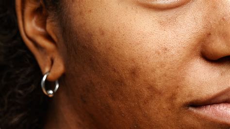 Is uneven skin tone treatable? We asked the experts to tell it like it is | Glamour UK