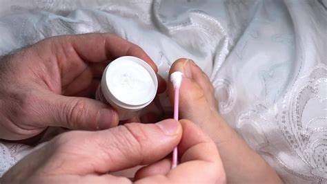 Water callus, blister on toe, seal with adhesive tape, spread with zinc ointment, treatment ...