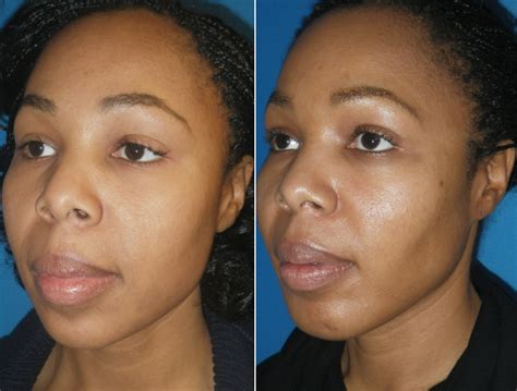 Buccal Fat Removal Under Chin at Ruth Leet blog