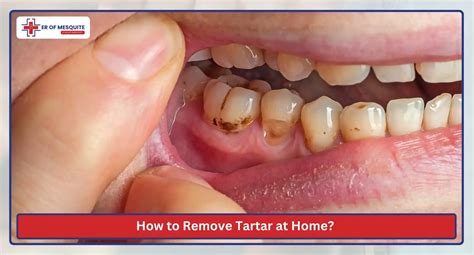 How to Get Plaque Off Teeth Safe, Effective Ways to Protect Your Smile