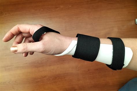 Sprained Wrist Treatment