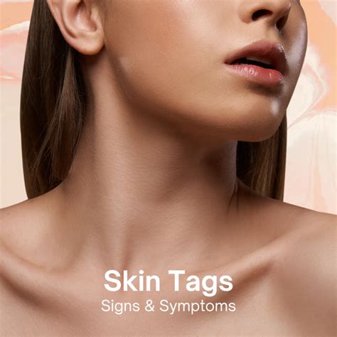 Understanding Skin Tags: Causes, Treatments, and Prevention