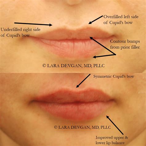 Hard Lumps On Lips After Filler at William Christy blog