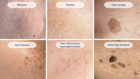 Hyperpigmentation Acne
