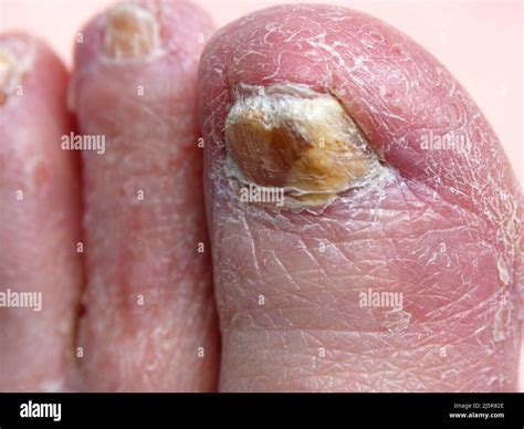 Why Are My Toenails Yellow Thick And Brittle at Jennie Wilson blog