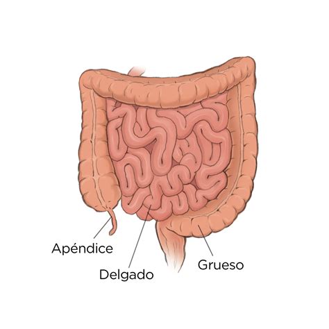 Cistectomía radical/Cirugía de extirpación de vejiga para el cáncer de ...
