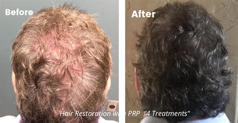 PRP Hair Restoration for Men