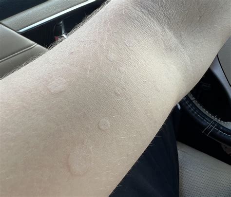 What are these spots on my arms? : r/Dermatology