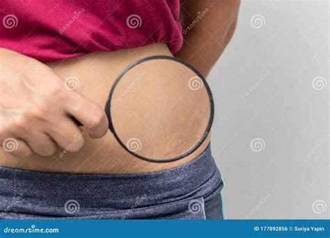 Women Show Off the Belly after Birth, Stretch Marks on White Background ...