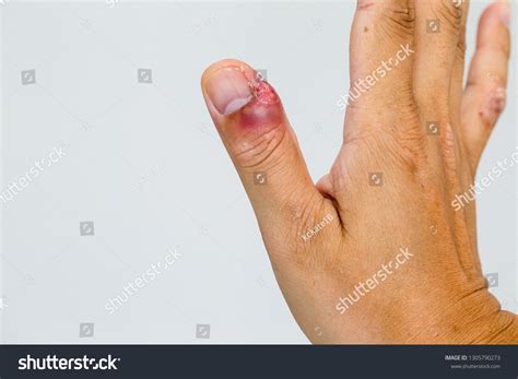 Finger Infection