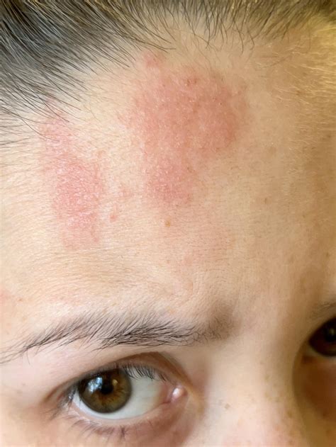 Itching Rash On Chin at Thomas Reiser blog