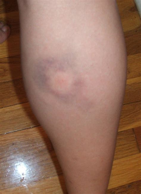 Can A Bug Bite Leave A Bruise at Lisa Cunningham blog