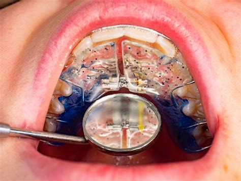 Palatal Expanders in Treasure Valley | Orthodontic Appliance