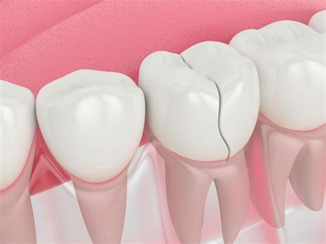 Procedures to Repair Your Cracked or Broken Tooth | Cracked Tooth