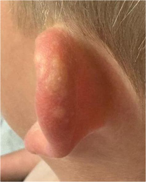 Juvenile Spring Eruption: Twice is Not Nice - The Journal of Pediatrics