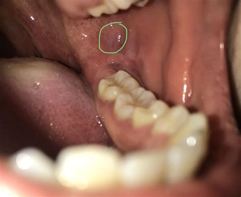 Cheek Biting Caused By Wisdom Teeth at Santos Long blog