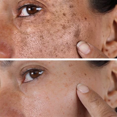 Acne Dark Spots On Face