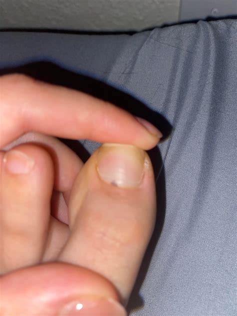 black spot on toe nail, what is this? : r/Dermatology