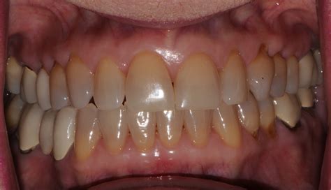 How To Remove Tobacco Stains From Dentures - Property & Real Estate for ...