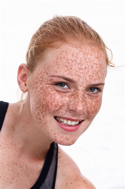 Freckles That Are Red