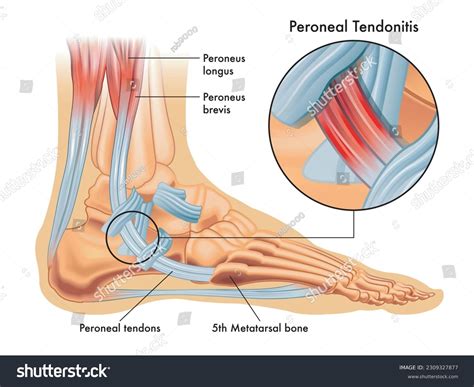 1+ Hundred Peroneal Tendonitis Royalty-Free Images, Stock Photos ...
