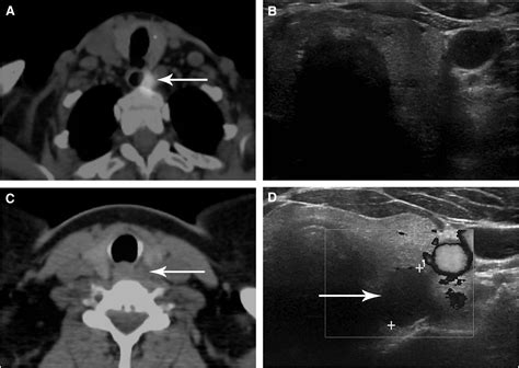 SPECT/CT-Guided Ultrasound for Parathyroid Adenoma Localization: A 1-Stop Approach | Journal of ...