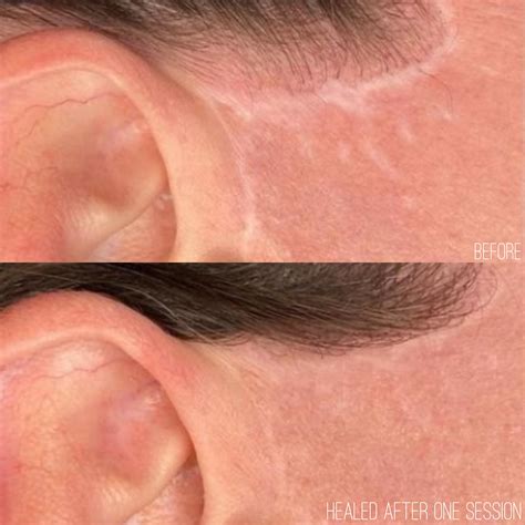 Scar Camouflage Tattooing — Inez Tattoo | Melbourne Cosmetic Tattoo Studio
