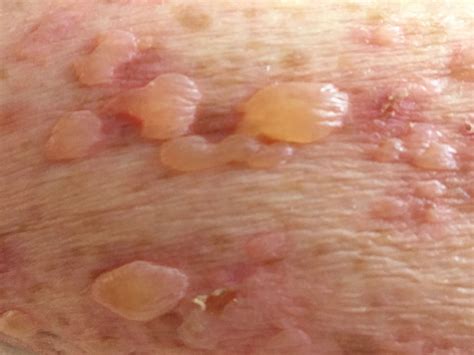 Once in a lifetime: Stevens-Johnson Syndrome - Pulse Today