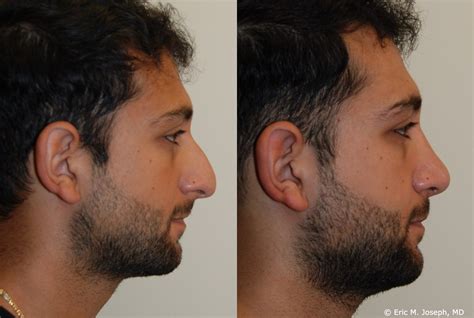 Nose Job Before And After Men