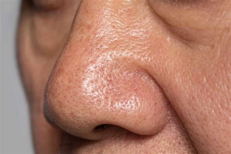 Enlarged Pores - Freyja Medical