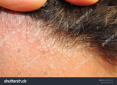 Seborrhoeic Dermatitis